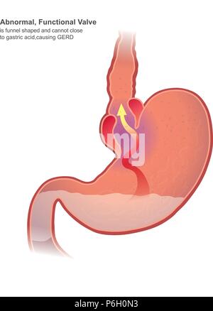 Malattia da reflusso gastroesofageo GERD, noto anche come reflusso acido, è sul lungo termine una condizione per cui i contenuti dello stomaco tornare indietro fino all'esofago, resul Illustrazione Vettoriale