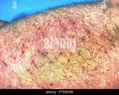 Grande e colorata livido sul corpo umano. Hurt doloroso luogo dopo incidente sportivo. Dettaglio del corpo maschio. Dolorosa per via sottocutanea il pregiudizio sulla pelle umana Foto Stock