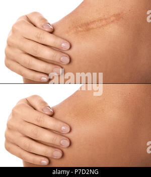 Risultato prima e dopo la procedura di cicatrice rimozione Foto Stock