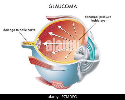 Vettore Illustrazione medica delle cause del glaucoma Illustrazione Vettoriale