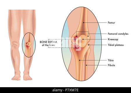 Un vettore Illustrazione medica dei sintomi di un edema osseo su un ginocchio. Illustrazione Vettoriale