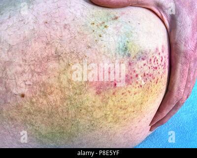Grande e colorata livido sul corpo umano. Hurt doloroso luogo dopo incidente sportivo. Dettaglio del corpo maschio. Dolorosa per via sottocutanea il pregiudizio sulla pelle umana Foto Stock