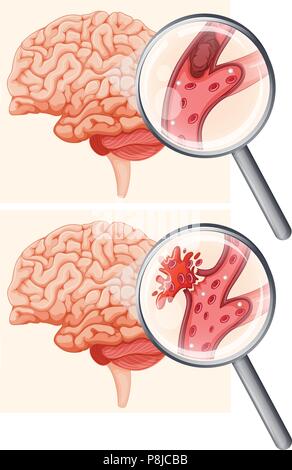 Cervello umano e Ictus emorragico illustrazione Illustrazione Vettoriale