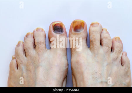 Oscurato ammaccati alluce (alluce) toenail sui piedi di un maschio caucasico scolorito con lividi trauma del letto ungueale (mal montaggio walking boot) Foto Stock