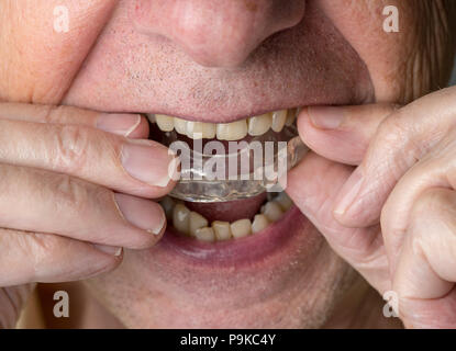 Senior uomo mettendo una guardia notturna su denti storti Foto Stock