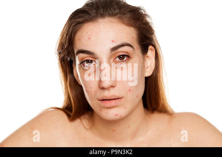 Una ragazza con sguardi stanchi, problemi di pelle e cerchi scuri attorno agli occhi. Tossicodipendenza da Droga concept Foto Stock