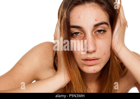 Una ragazza con sguardi stanchi, problemi di pelle e cerchi scuri attorno agli occhi. Tossicodipendenza da Droga concept Foto Stock