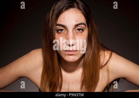 Una ragazza con sguardi stanchi, problemi di pelle e cerchi scuri attorno agli occhi. Tossicodipendenza da Droga concept Foto Stock