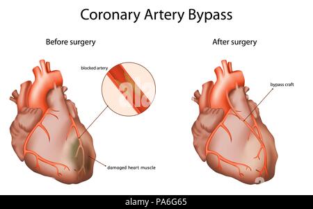 Di bypass di arteria coronaria, illustrazione. L'innesto di bypass consente di ripristinare il normale flusso sanguigno ad un ostacolato arteria coronaria. Foto Stock