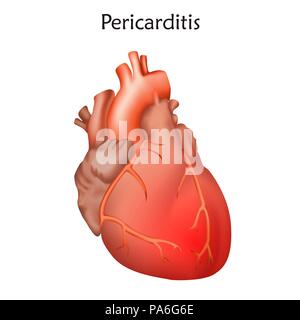 Pericardite, illustrazione. Pericardite è una infiammazione del pericardio, la membrana che racchiude il cuore. Foto Stock