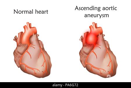 Ordine crescente aneurisma aortico, illustrazione. Confronto tra un danneggiato e normale del cuore. Foto Stock