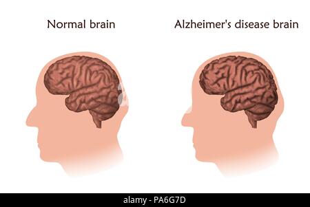 Il morbo di Alzheimer, illustrazione. Il confronto di un normale cervello invecchiato e il cervello di una persona con Alzheimer. Foto Stock