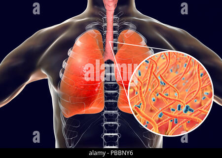 La pertosse, illustrazione concettuale. La pertosse è altamente contagiosa malattia infettiva causata da batteri Bordetella pertussis. Foto Stock