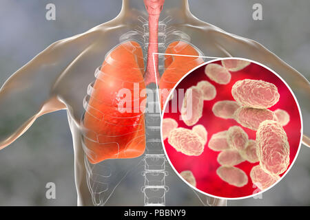 La pertosse, illustrazione concettuale. La pertosse è altamente contagiosa malattia infettiva causata da batteri Bordetella pertussis. Foto Stock