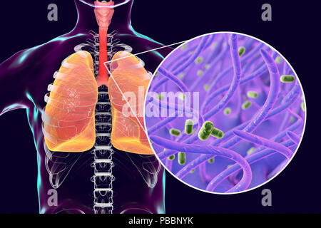 La pertosse, illustrazione concettuale. La pertosse è altamente contagiosa malattia infettiva causata da batteri Bordetella pertussis. Foto Stock