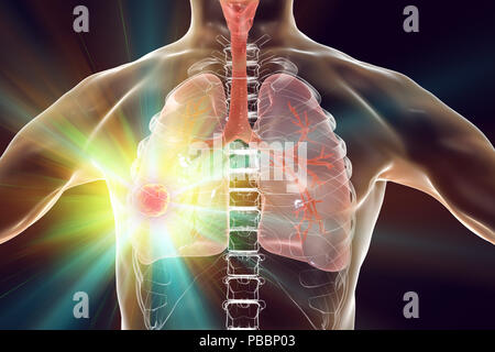 Il trattamento e la prevenzione del cancro del polmone, concettuale illustrazione del computer. Foto Stock