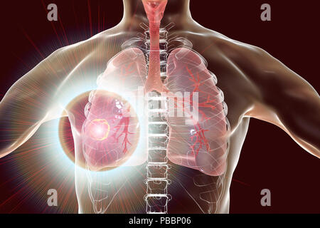 Il trattamento e la prevenzione del cancro del polmone, concettuale illustrazione del computer. Foto Stock