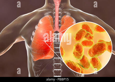 La polmonite causata da Haemophilus influenzae batteri, illustrazione del computer. H. influenzae sono coccobacillo gram-negativi. Questi batteri causano una serie di malattie tra cui la meningite nei bambini, polmonite, epiglottide, laringiti, congiuntivite, infezioni neonatali, otite media (infezione dell'orecchio medio) e sinusite negli adulti. H. influenzae innocuamente colonizzare il tratto respiratorio superiore nella maggior parte degli esseri umani nei primi mesi di vita. Ceppi incapsulati diffondersi a causa di malattie come bronchiti e polmoniti. Foto Stock