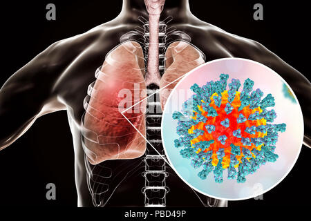 La polmonite causata dal virus del morbillo, concettuale illustrazione del computer. Virus del morbillo, virus dal Morbillivirus gruppo di virus, consiste di un RNA (acido ribonucleico) nucleo circondato da un involucro studded con le proteine di superficie emagglutinina-neuraminidasi e proteina di fusione, che vengono usati per collegare e penetrare in una cellula ospite. Il morbillo è altamente contagiosa pruriginoso con la febbre. Esso riguarda principalmente i bambini, ma un attacco di solito dà vita lunga immunità. La polmonite è uno dei comuni complicazioni del morbillo. Foto Stock