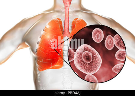 Polmonite da Pneumocystis, concettuale illustrazione del computer. Questa infezione polmonare è la più comune malattia opportunistiche nelle persone infettate con HIV (il virus di immunodeficienza umana ed è causata dal fungo Pneumocystis jaroveci (precedentemente P. carinii). Il trattamento prevede l'uso di antibiotici e di riposo a letto. Foto Stock