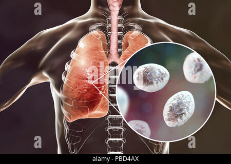 Polmonite da Pneumocystis, concettuale illustrazione del computer. Questa infezione polmonare è la più comune malattia opportunistiche nelle persone infettate con HIV (il virus di immunodeficienza umana ed è causata dal fungo Pneumocystis jaroveci (precedentemente P. carinii). Il trattamento prevede l'uso di antibiotici e di riposo a letto. Foto Stock