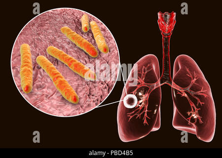 A fibrosi cavernosa tubercolosi polmonare e vista ravvicinata di Mycobacterium tuberculosis batteri, l'agente causativo della tubercolosi. Computer illustrazione che mostra la caverna (cavità) nel polmone destro con un ben formato lo strato fibroso nella sua parete. Foto Stock