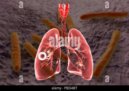 A fibrosi cavernosa tubercolosi polmonare. Computer illustrazione che mostra la caverna (cavità) nel polmone destro con un ben formato lo strato fibroso nella sua parete. Immagine di sfondo rappresenta illustrazione di Mycobacterium tuberculosis batteri, l'agente causativo della tubercolosi. Foto Stock