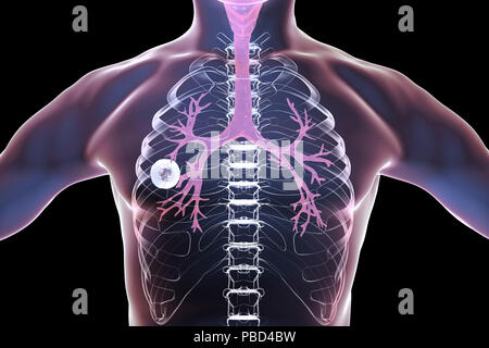 A fibrosi cavernosa tubercolosi polmonare. Computer illustrazione che mostra la caverna (cavità) nel polmone destro con un ben formato lo strato fibroso nella sua parete. Foto Stock