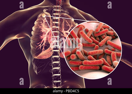 Secondaria infezione da tubercolosi e vista ravvicinata di Mycobacterium tuberculosis batteri, l'agente causativo della tubercolosi. Computer illustrazione che mostra di piccole dimensioni nodulare solida massa situato nel lobo superiore del polmone destro vicino all apice del polmone. Foto Stock