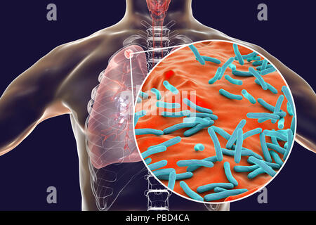 Secondaria infezione da tubercolosi e vista ravvicinata di Mycobacterium tuberculosis batteri, l'agente causativo della tubercolosi. Computer illustrazione che mostra di piccole dimensioni nodulare solida massa situato nel lobo superiore del polmone destro vicino all apice del polmone. Foto Stock