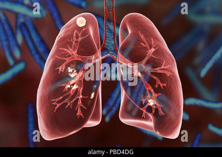 Secondaria infezione da tubercolosi. Computer illustrazione che mostra di piccole dimensioni nodulare solida massa situato nel lobo superiore del polmone destro vicino all apice del polmone. Immagine di sfondo rappresenta illustrazione di Mycobacterium tuberculosis batteri, l'agente causativo della tubercolosi. Foto Stock
