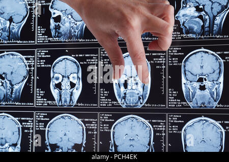 La risonanza magnetica la scansione del cervello. Testa di MRI scan. Foto Stock