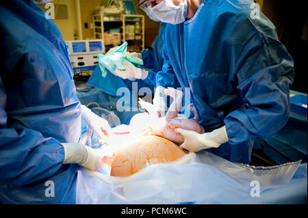 Una donna di parto gemellare mediante taglio cesareo (Heverlee, 30/12/2016) Foto Stock