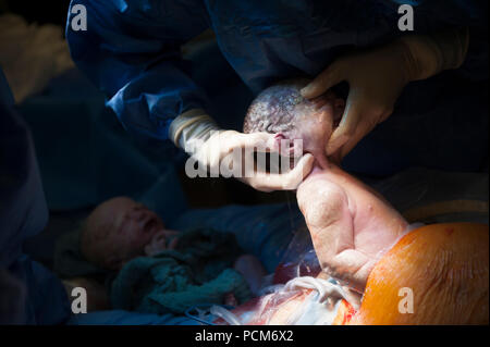 Una donna di parto gemellare mediante taglio cesareo (Heverlee, 30/12/2016) Foto Stock