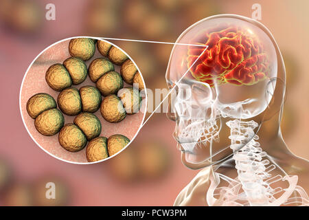 La Neisseria meningitidis infezione cerebrale, illustrazione del computer. N. meningitidis sono gram-negativi diplococci (batteri sferiche disposte in coppie), trasmessi tramite la via respiratoria. Nella maggior parte delle persone provocano infezioni asintomatiche o non gravi nasopharingitis, ma può anche causare gravi meningite e infezione generalizzata (meningococcaemia), in particolare per i bambini. La loro superficie è ricoperta con pilli che prendere parte in attacco di batteri per cellule e superfici. Foto Stock