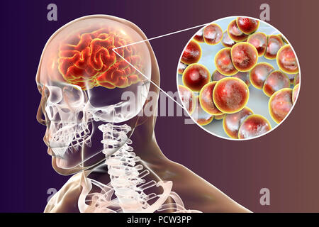 La Neisseria meningitidis infezione cerebrale, illustrazione del computer. N. meningitidis sono gram-negativi diplococci (batteri sferiche disposte in coppie), trasmessi tramite la via respiratoria. Nella maggior parte delle persone provocano infezioni asintomatiche o non gravi nasopharingitis, ma può anche causare gravi meningite e infezione generalizzata (meningococcaemia), in particolare per i bambini. La loro superficie è ricoperta con pilli che prendere parte in attacco di batteri per cellule e superfici. Foto Stock
