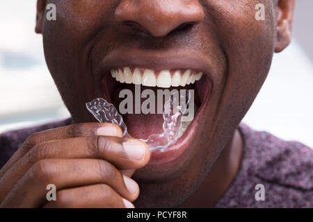 Close-up di un uomo di regolazione di allineatori trasparenti nei suoi denti bianchi Foto Stock