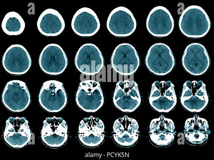 CT Brain Foto Stock