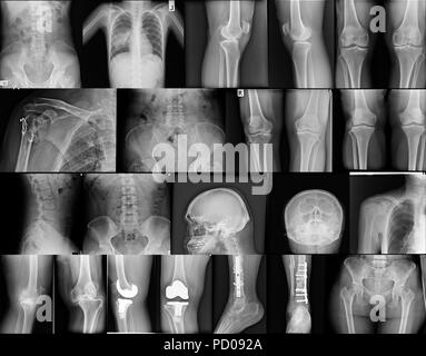 Collezione x-ray in tonalità di grigio Foto Stock