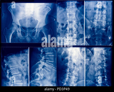 Colorate in blu immagini a raggi X di un bacino umano e la colonna vertebrale Foto Stock