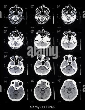 Sequenza di sezioni orizzontali di una femmina di cervello umano, MRI esegue la scansione e il rilevamento di immagini in risonanza magnetica nucleare, Foto Stock