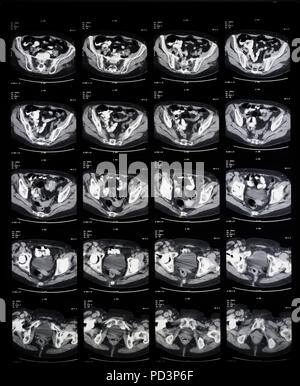 Sequenza di sezioni orizzontali di una femmina di cervello umano, MRI esegue la scansione e il rilevamento di immagini in risonanza magnetica nucleare, Foto Stock