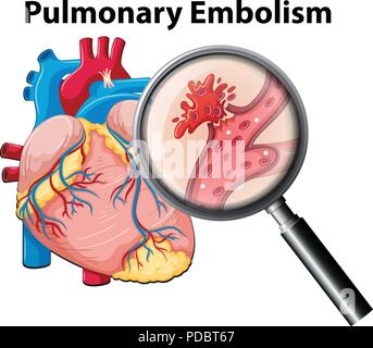 Anutomy umana embolia polmonare illustrazione Illustrazione Vettoriale