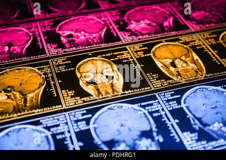 La risonanza magnetica la scansione del cervello. Testa di MRI scan. Foto Stock