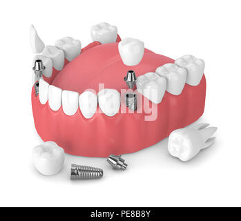 3D render della ganascia con impianti dentali e ponti su sfondo bianco Foto Stock