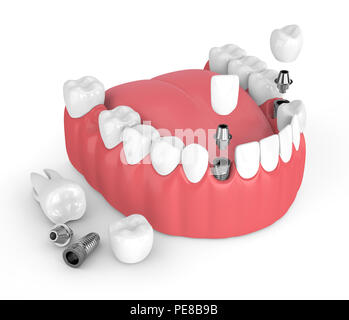 3D render della ganascia con impianti dentali su sfondo bianco Foto Stock