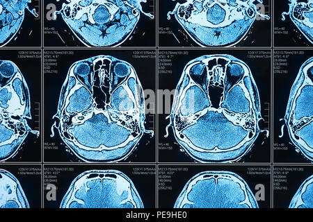 Intelligenza artificiale in smart healthcare ospedale concetto tecnologico. AI biomedici e algoritmo di apprendimento automatico in grado di rilevare il cervello polmonite e Annulla Foto Stock