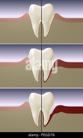 La malattia periodontale, gengiviti e infiammazione gengivale rendering 3d'illustrazione. Per le cure dentarie. Foto Stock