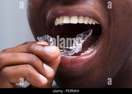 Close-up di un uomo di regolazione di allineatori trasparenti nei suoi denti bianchi Foto Stock
