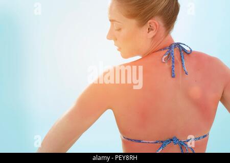 Donna con la schiena bruciata dal sole, in vista posteriore Foto Stock